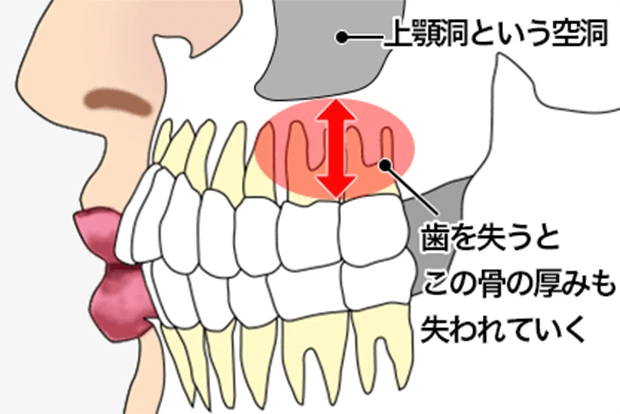 歯を失うと上あごの骨の厚みが失われていく様子の図