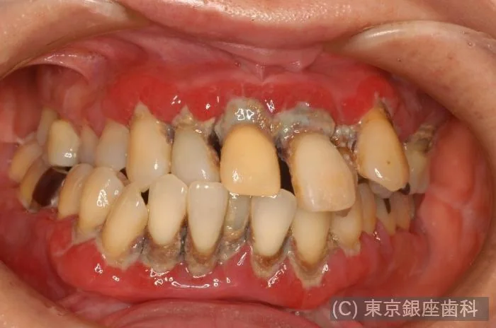 症例2 治療前の歯