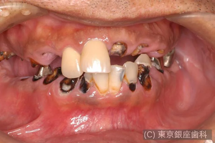 症例3 治療前の歯