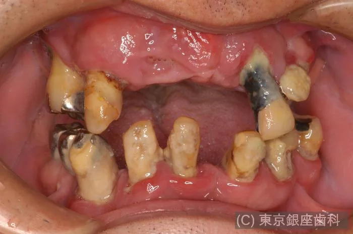症例4 治療前の歯