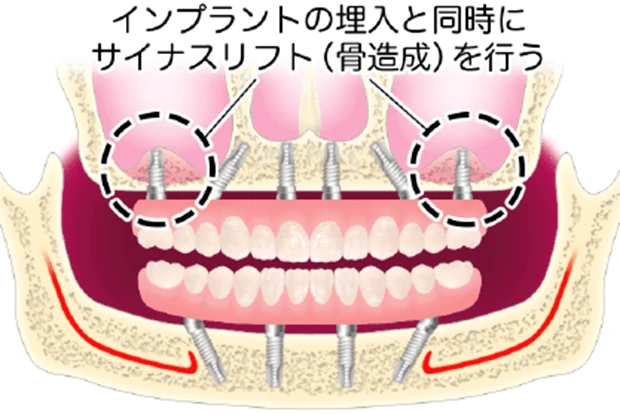 インプラントの埋入と同時にサイナスリフトを行う図